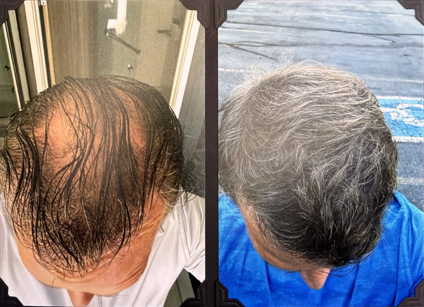 Before and after hair restoration result 1