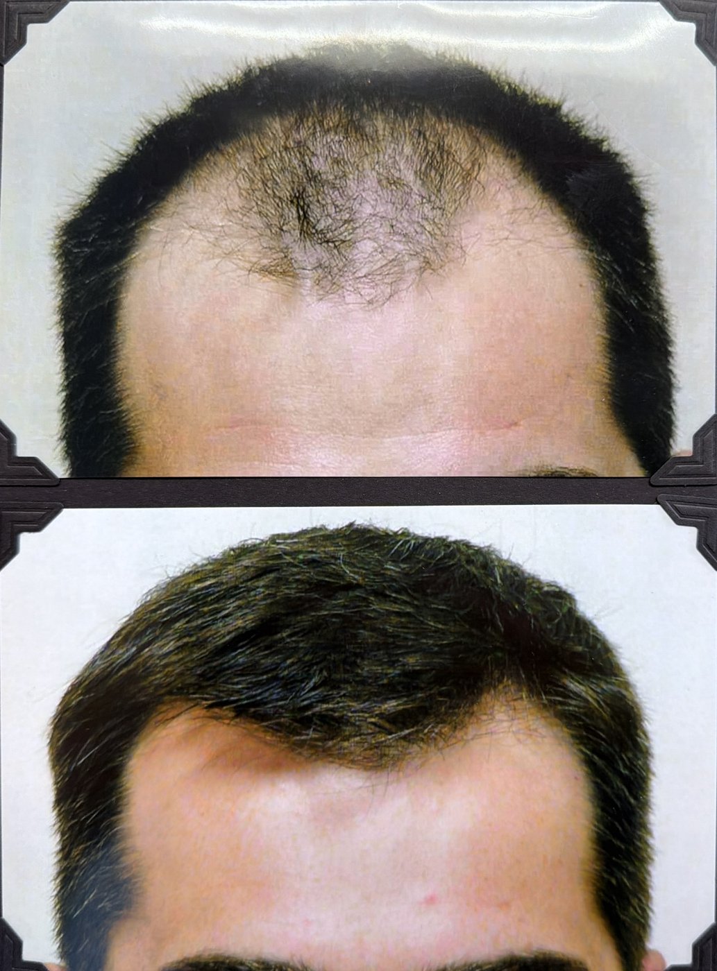 Before and after hair restoration result 2