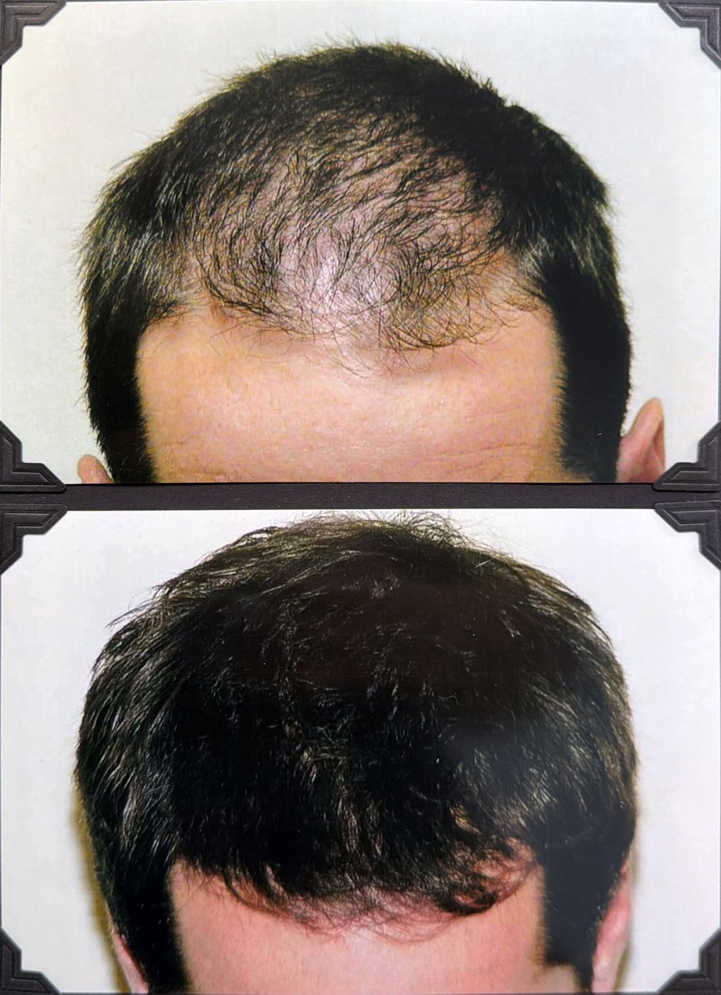 Before and after hair restoration result 3