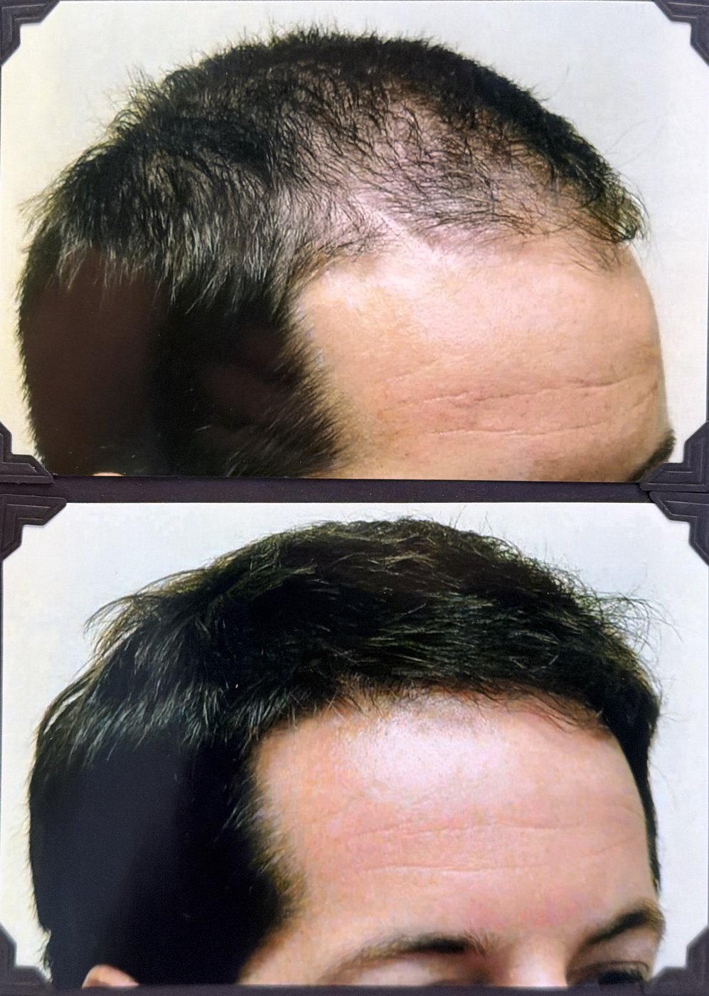 Before and after hair restoration result 4