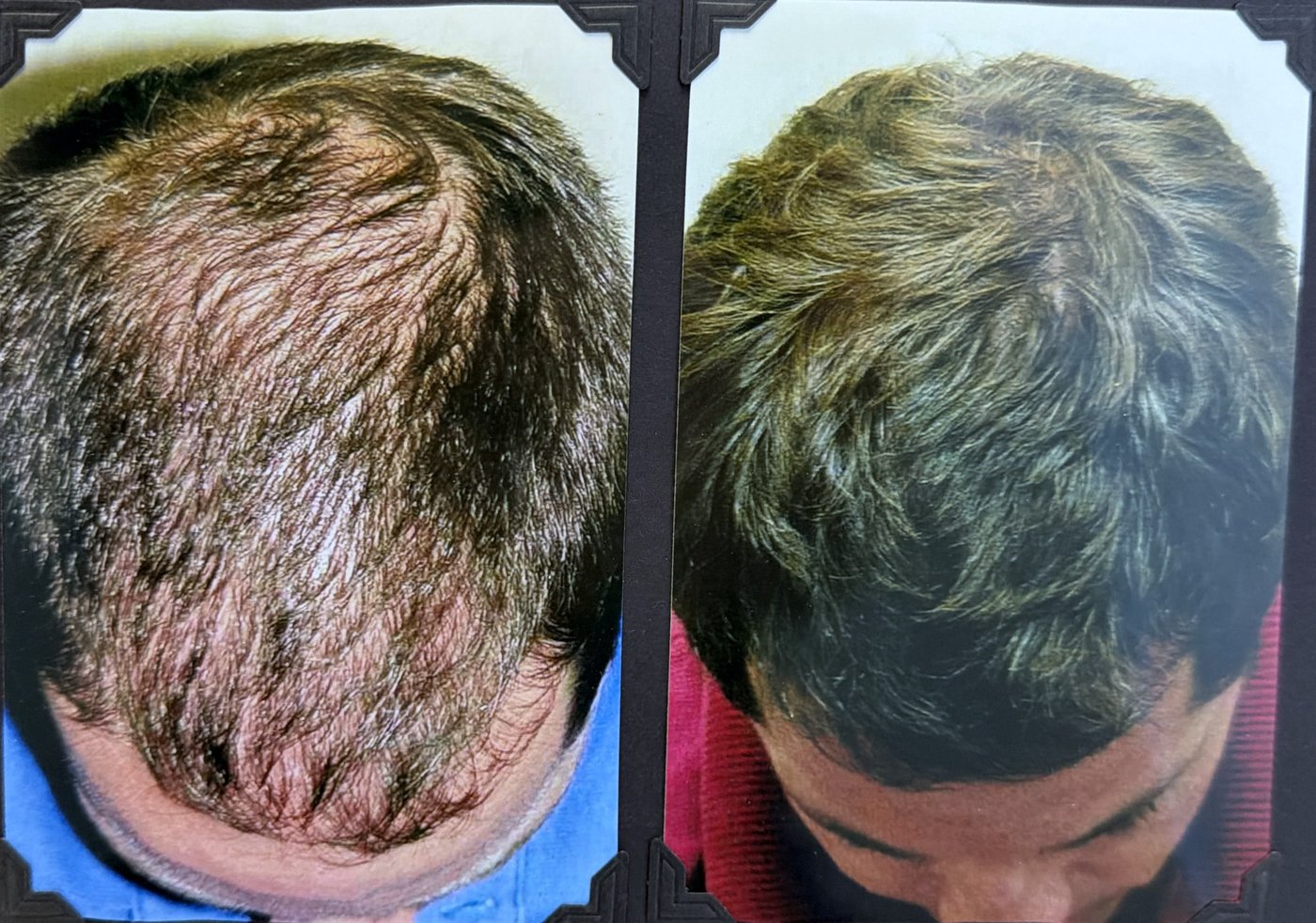 Before and after hair restoration result 5