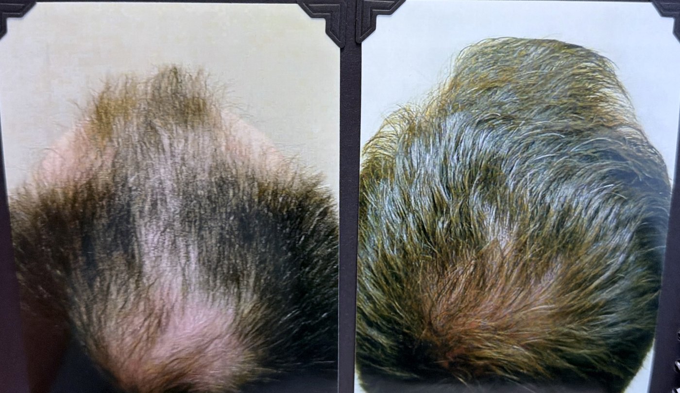 Before and after hair restoration result 6
