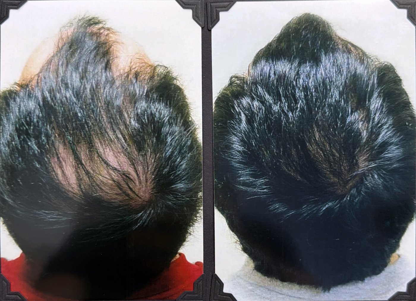 Before and after hair restoration result 8