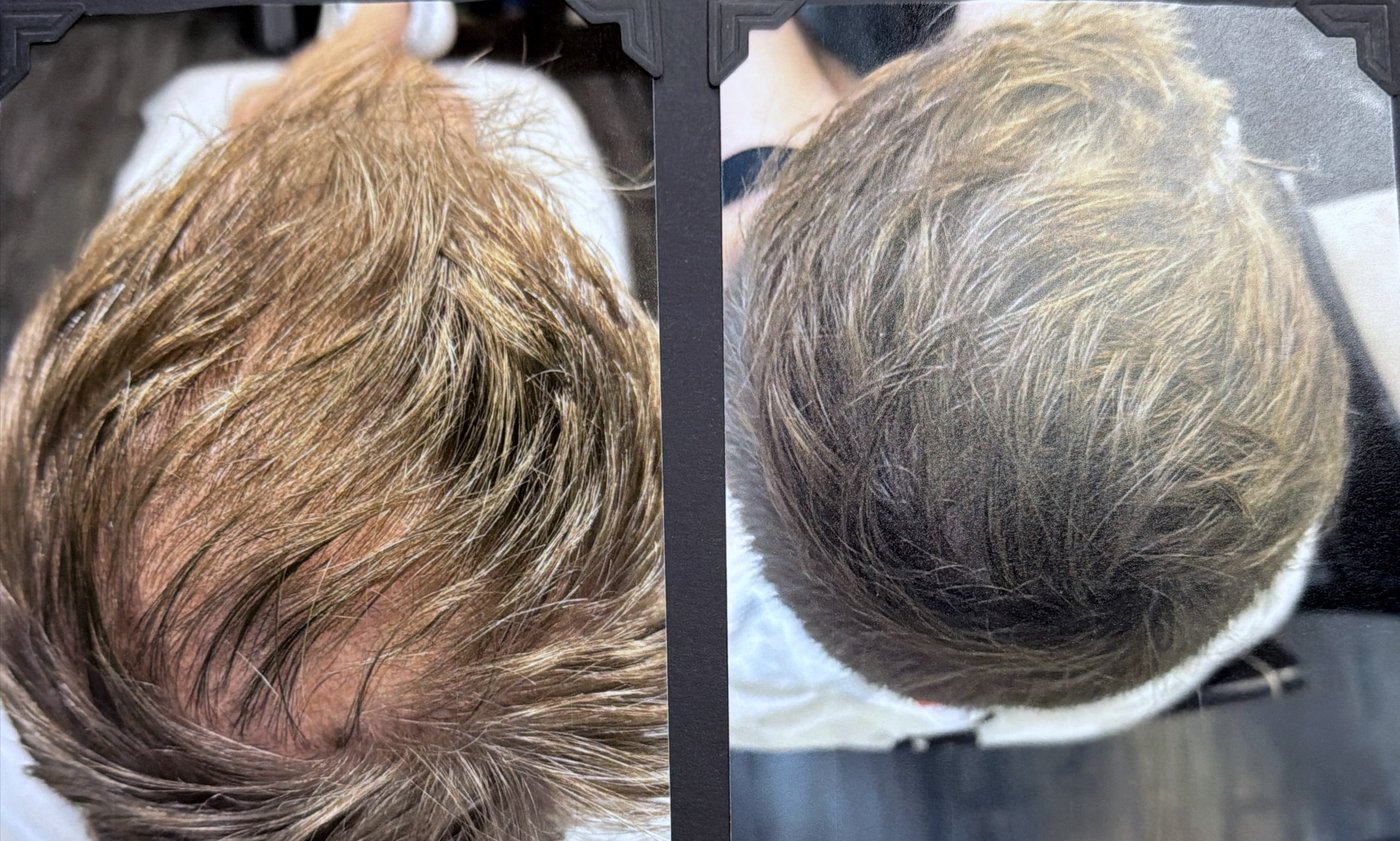 Before and after hair restoration result 10