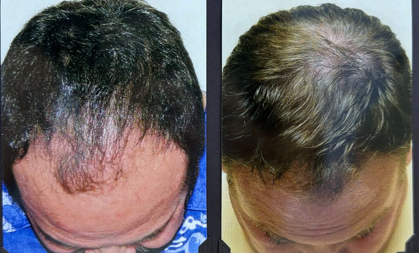 Before and after hair restoration result 13