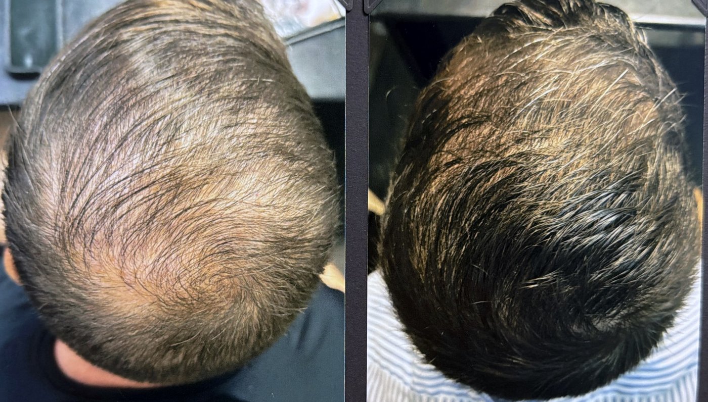 Before and after hair restoration result 14