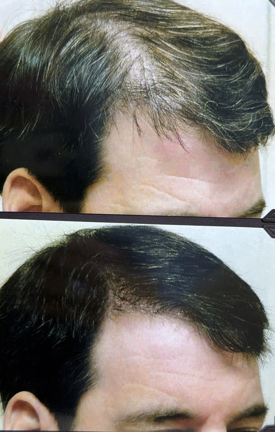 Before and after hair restoration result 15