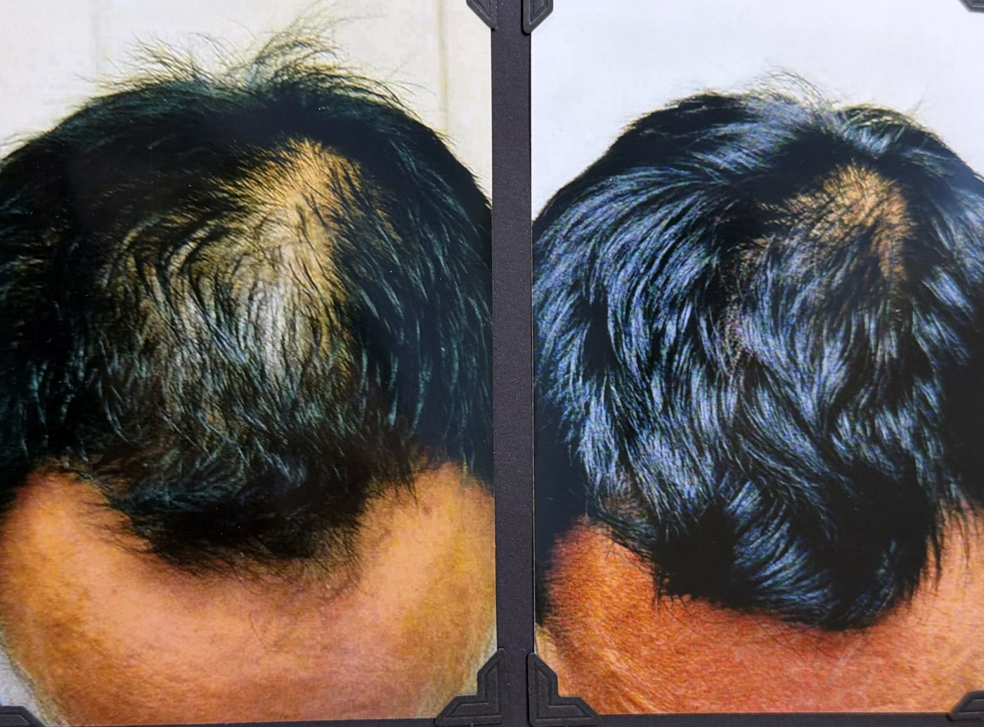 Before and after hair restoration result 16