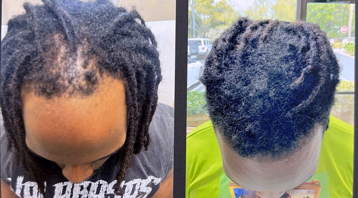 Before and after hair restoration result 17