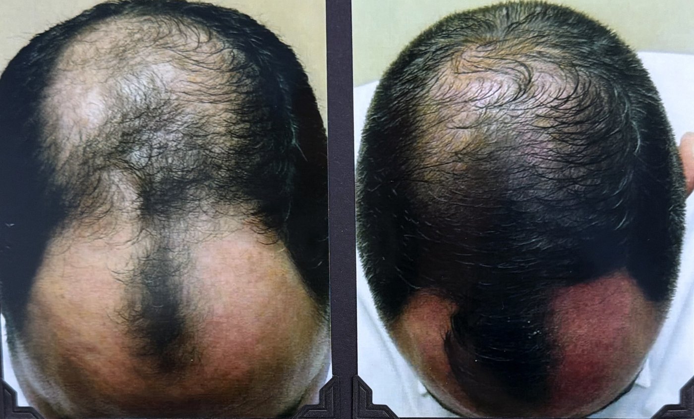 Before and after hair restoration result 18