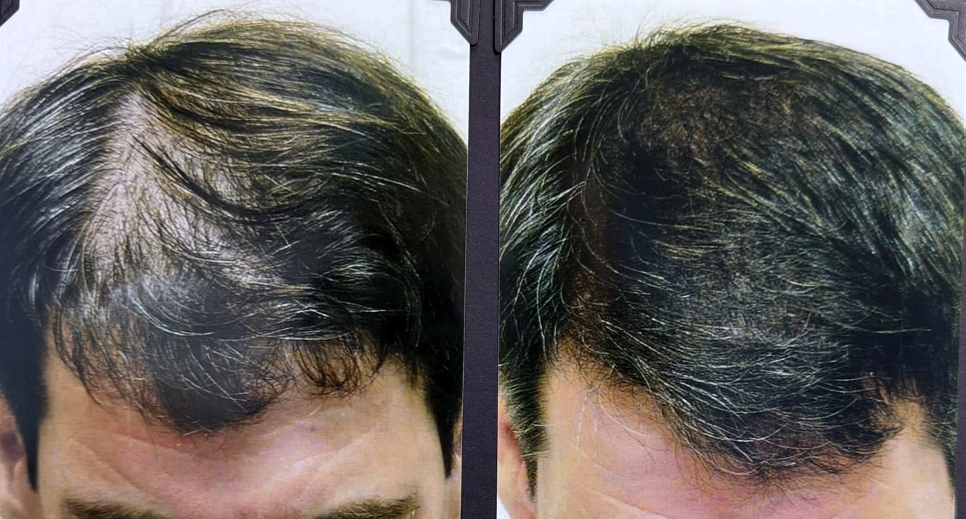 Before and after hair restoration result 19