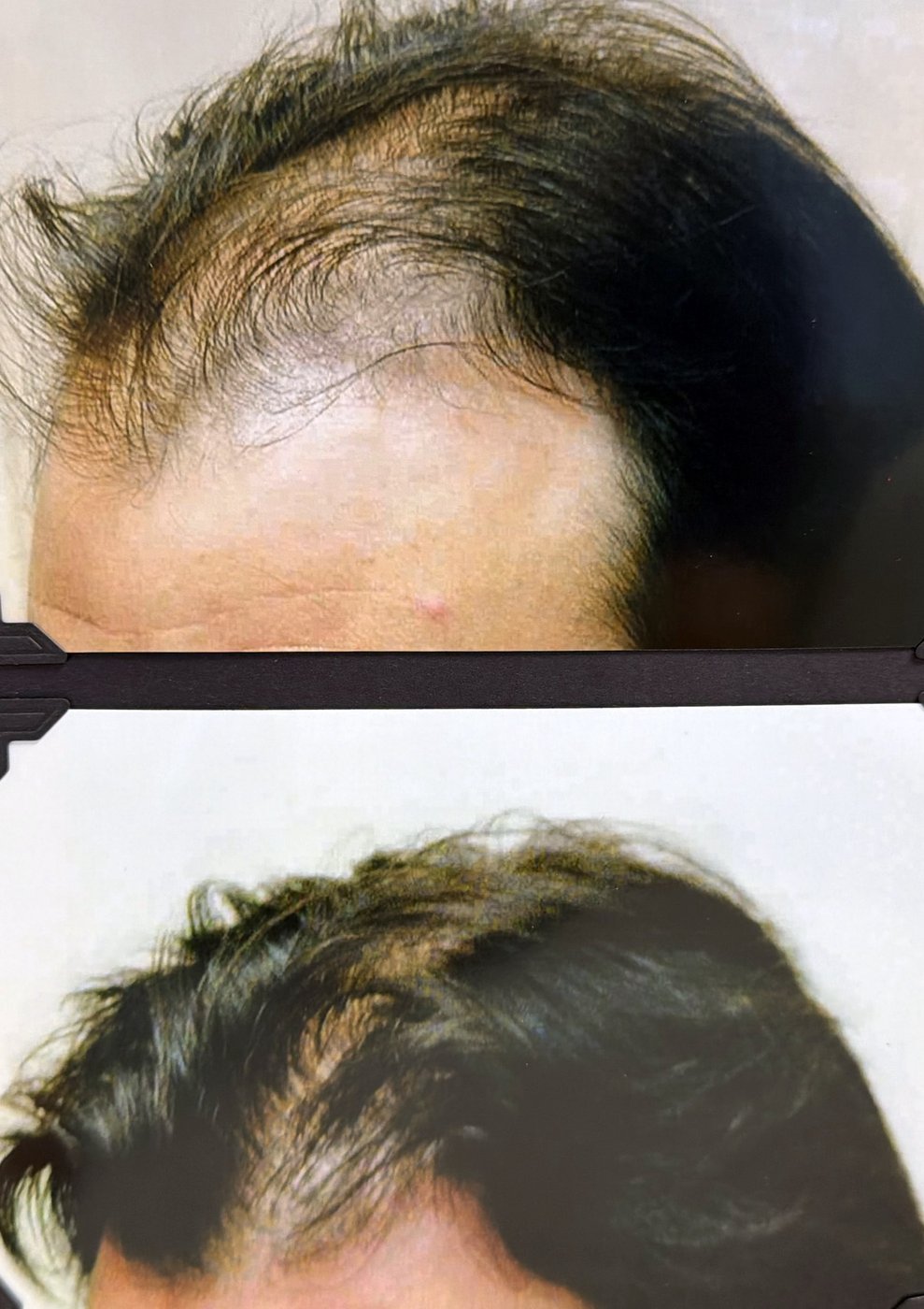 Before and after hair restoration result 20