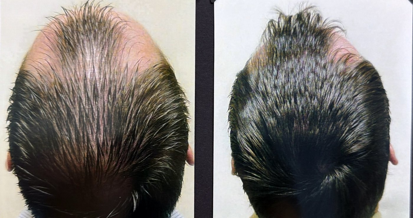 Before and after hair restoration result 22