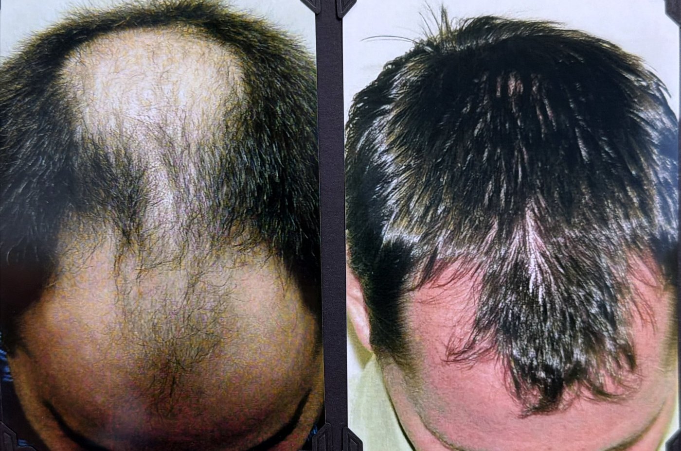 Before and after hair restoration result 24