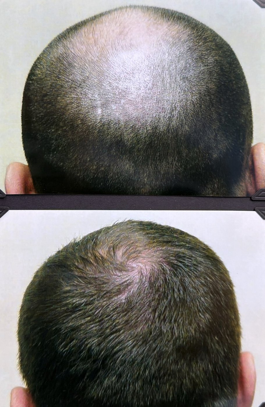 Before and after hair restoration result 26